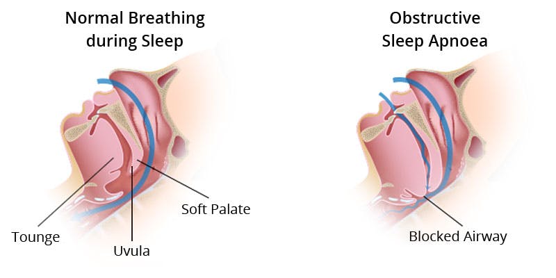 Obstructive Sleep Apnoea (OSA)